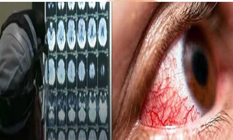 2nd Death, 8 Suspected Black Fungus Cases In J&K